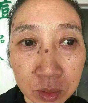 去老年斑的簡單方法，重拾肌膚光彩的秘訣，去老年斑秘籍，重拾肌膚光彩的簡易方法