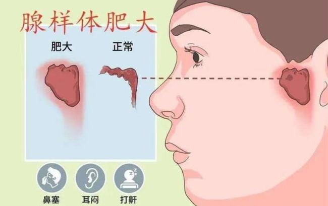 腺樣體肥大能自愈嗎？——深度解析與理解，腺樣體肥大能否自愈？全面深度解析