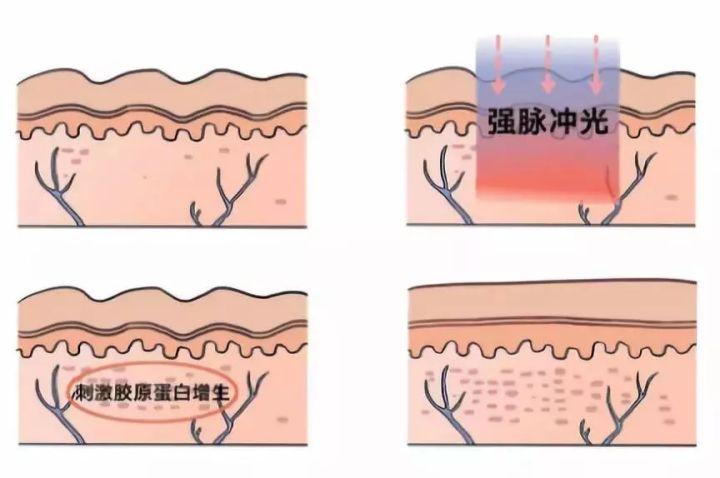 簡單有效的痘坑修復方法，讓你的肌膚重拾光彩，簡單有效的痘坑修復秘訣，重塑肌膚光彩！