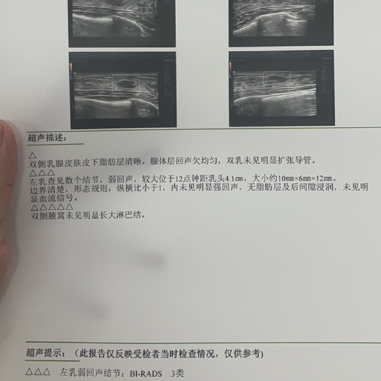 乳腺結節3類嚴重嗎？解讀乳腺健康，讓你了解真相，乳腺結節3類嚴重嗎？解讀乳腺健康真相