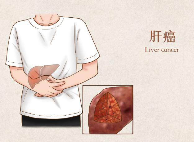 肝癌一般三處痛，癥狀解析與應對策略，肝癌癥狀解析，疼痛位置、應對策略及三處痛詳解