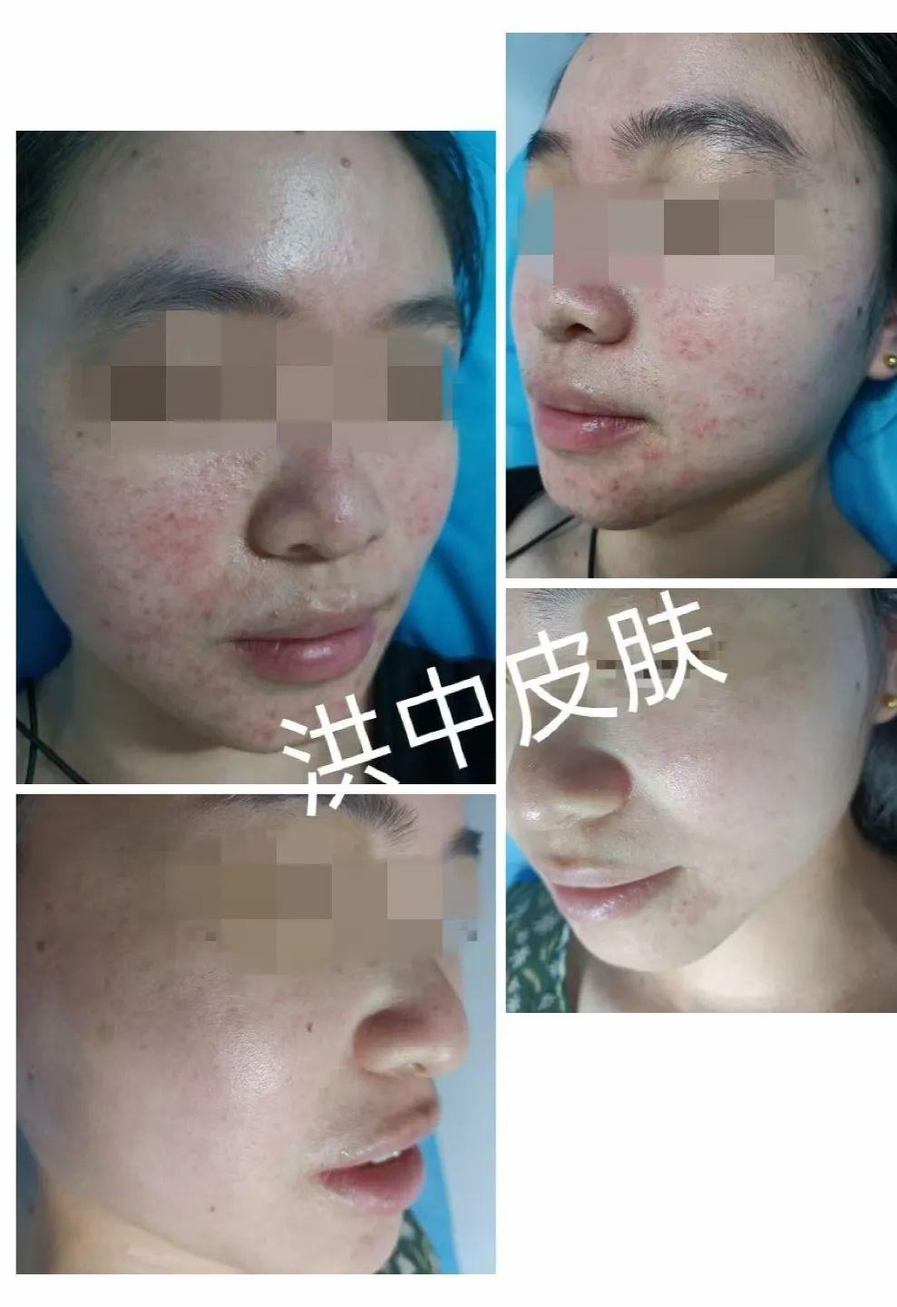 痤瘡圖片的樣子，深入了解痤瘡癥狀與表現(xiàn)，痤瘡癥狀深度解析，圖片展示痤瘡表現(xiàn)與形態(tài)