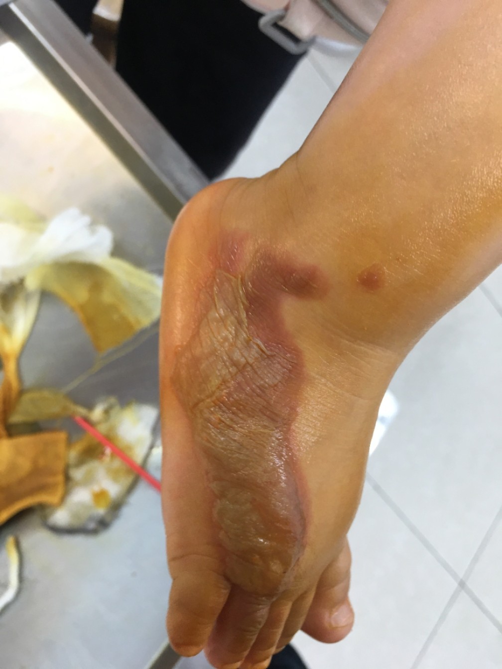 燙傷后如何選用最佳藥膏，避免留下疤痕，燙傷藥膏選擇與疤痕預防，燙傷后的最佳護理指南