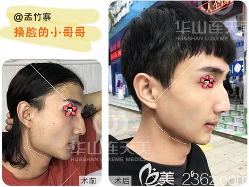 削顴骨手術(shù)費用詳解，手術(shù)費用大概要多少錢？，削顴骨手術(shù)費用詳解，手術(shù)費用及預算指南