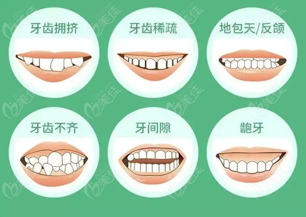 牙齒正畸費用詳解，一般多少？，牙齒正畸費用全面解析，了解一般價格及影響因素
