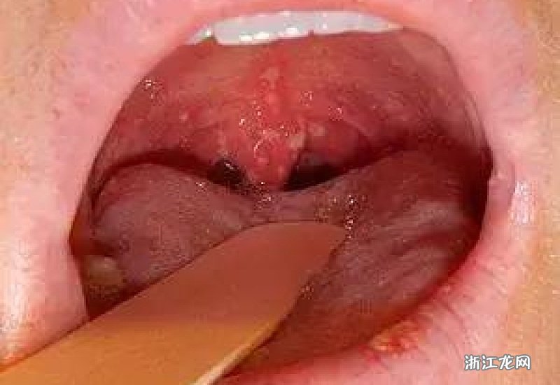 皰疹性咽峽炎五個分期詳解，皰疹性咽峽炎的五個分期詳解及特點解析