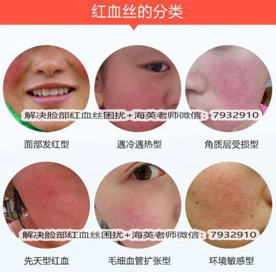 臉上出現紅血絲怎么治療，全面解析有效方法，臉上紅血絲全面解析與有效治療方法