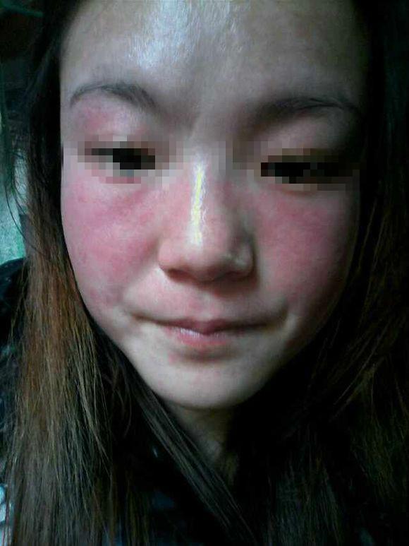 如何去掉黃褐斑的最好辦法，如何有效去除黃褐斑的方法探究