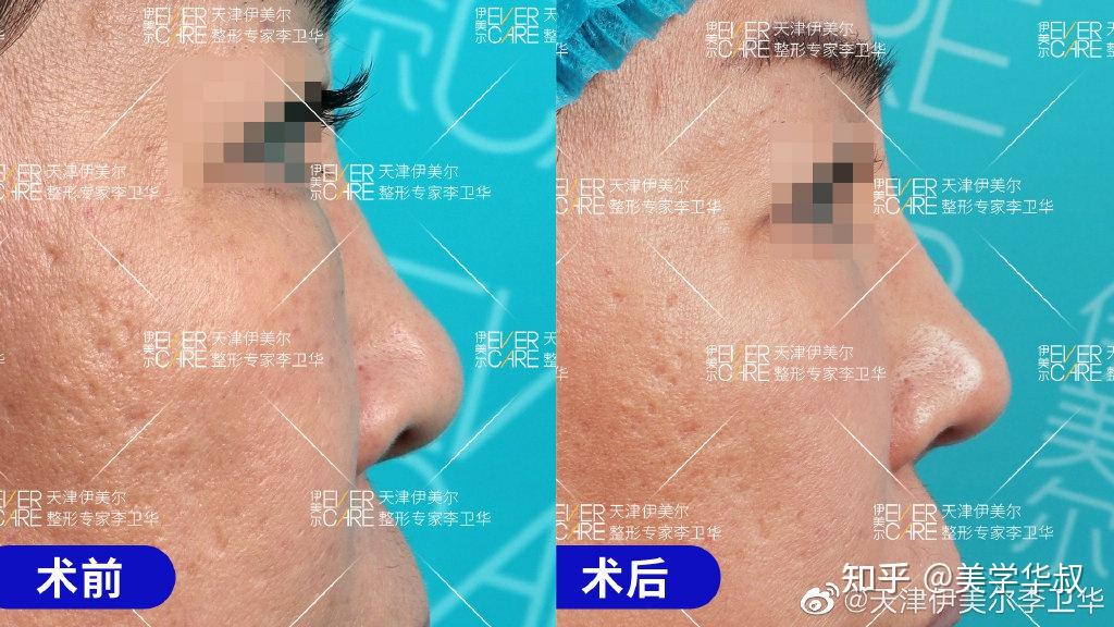 捏鼻三年，鼻頭變大——深度解析捏鼻子對鼻子的影響及應對之策，捏鼻三年的影響，鼻頭變大原因解析與應對之策