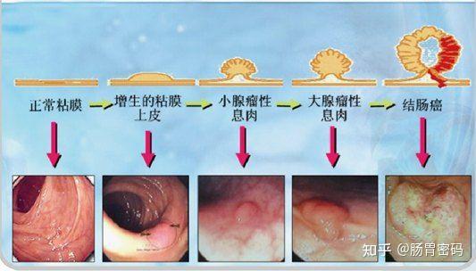 肛門息肉早期圖片及其相關介紹,肛門息肉早期圖片與詳細介紹