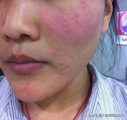 紅血絲怎么改善，全方位解決方案，全方位解決方案，改善紅血絲，重塑肌膚健康光彩