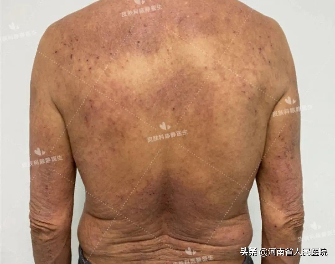 濕疹的樣子圖片,深入了解濕疹癥狀與表現,濕疹癥狀與表現詳解,圖片展示,助你深入了解濕疹特征