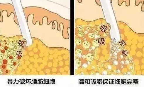 腹部吸脂肪大概需要多少錢——全面了解腹部吸脂手術(shù)費用,腹部吸脂手術(shù)費用全面解析,了解腹部吸脂肪所需大致費用