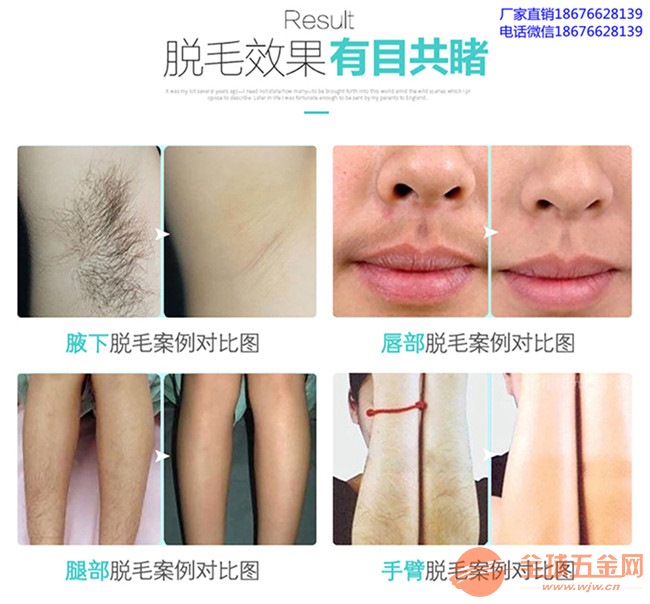 激光脫毛,價格因素詳解,激光脫毛詳解,價格因素剖析