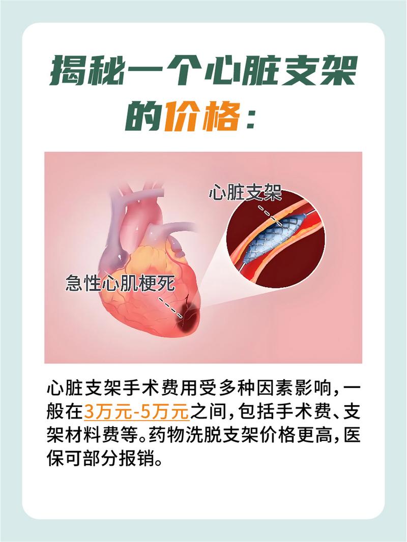 關于血管支架的價格,你需要知道的一切,血管支架價格全解析,你需要了解的一切