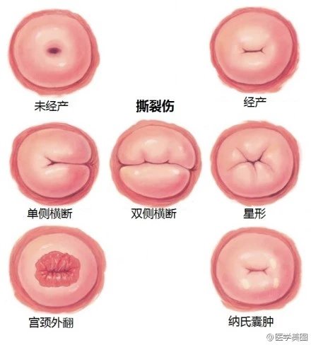 正常宮頸口的照片,了解、識別與關注女性健康,女性健康知識普及,正常宮頸口照片,識別與關注宮頸健康