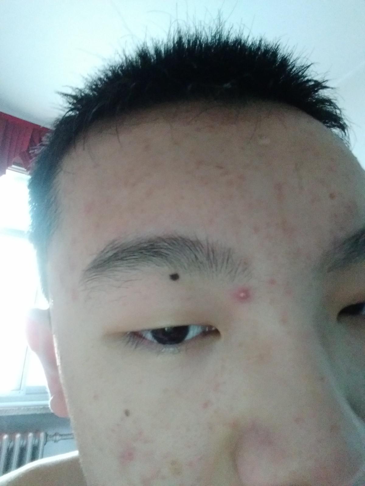 臉上痘痘太多了怎么辦?全方位護膚指南助你擺脫困擾,全方位護膚指南,解決臉部痘痘困擾,重拾肌膚光彩