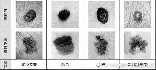 黑色素痣有必要切除嗎?——深入了解黑色素痣與切除決策,黑色素痣的切除決策,了解與選擇
