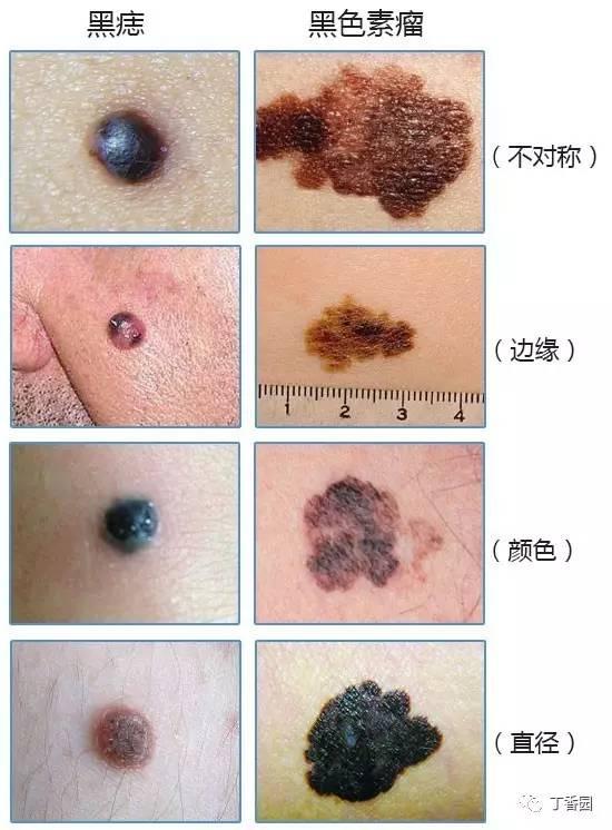 黑色素痣有必要切除嗎?——深入了解黑色素痣與切除決策,黑色素痣的切除決策,了解與選擇