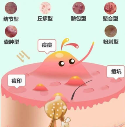 痤瘡忌口食物清單,戰(zhàn)勝痘痘,從飲食開始,戰(zhàn)勝痘痘,痤瘡忌口食物清單助你調(diào)整飲食,遠(yuǎn)離皮膚困擾