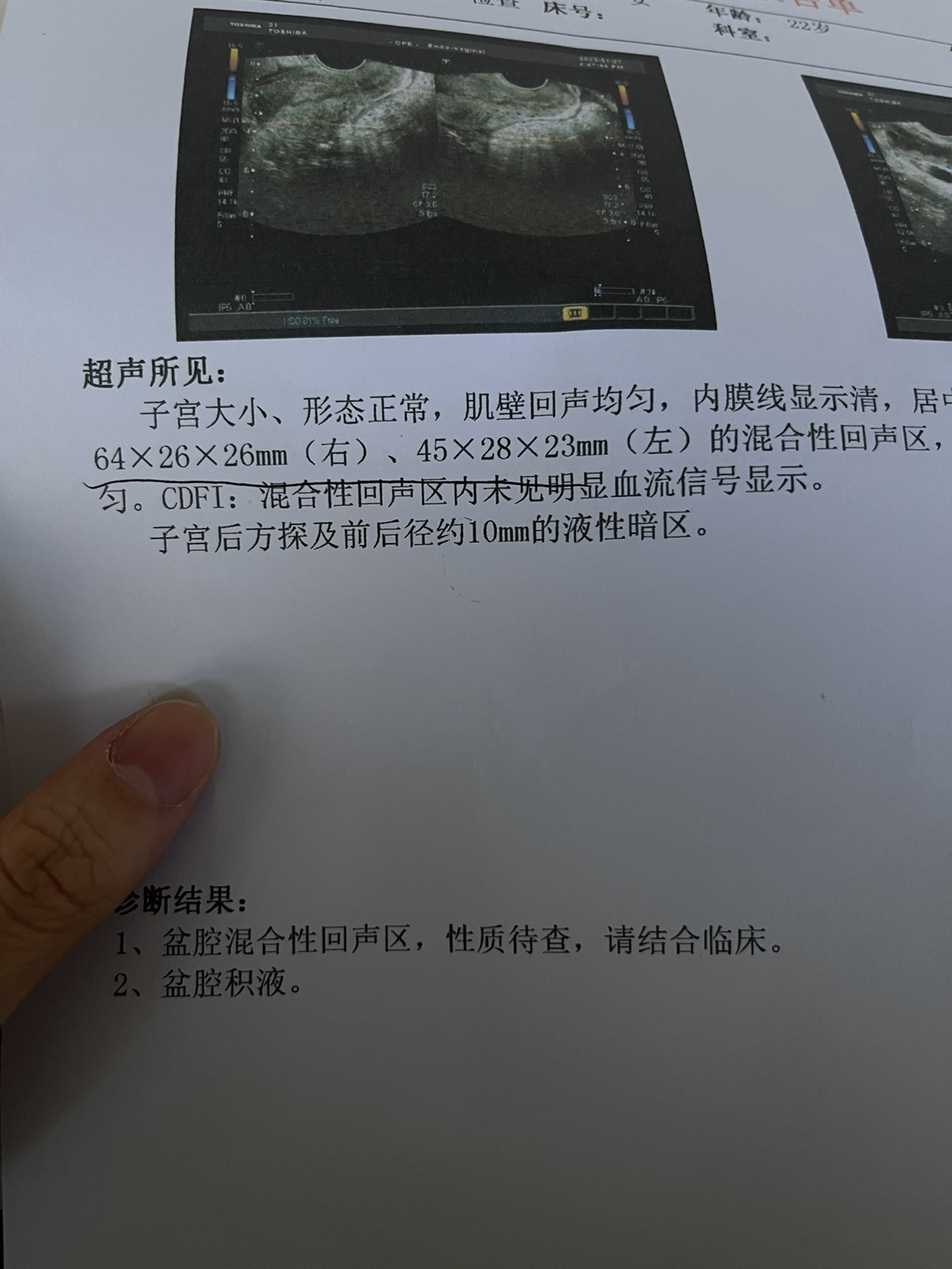 盆腔積液怎么治療,全面解析最佳治療方案,全面解析,盆腔積液的最佳治療方案