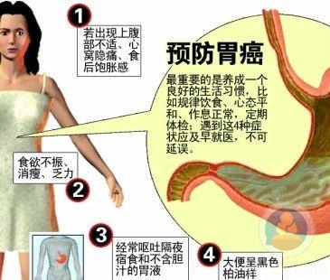 女胃癌的早期癥狀,了解并預防的關鍵信息,女性胃癌早期癥狀解析,預防與關鍵信息指南