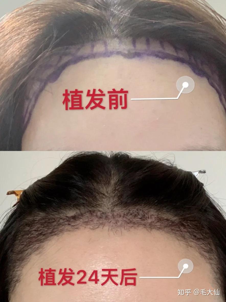 關于發際線植發的費用,你需要知道的一切,發際線植發費用全解析