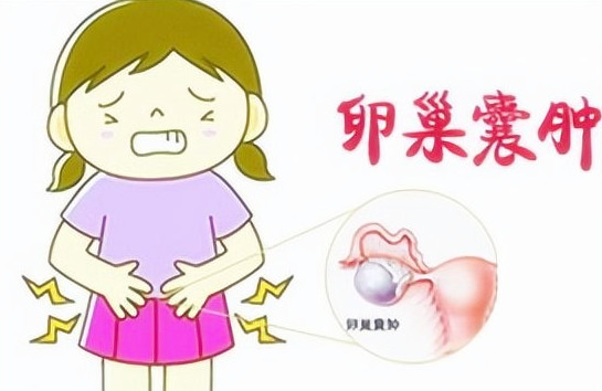 卵巢囊腫的十個征兆,卵巢囊腫的十個征兆解析