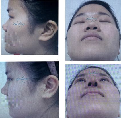 鼻頭縮小整形價(jià)格詳解,因素、費(fèi)用及注意事項(xiàng),鼻頭縮小整形價(jià)格解析,費(fèi)用、因素與注意事項(xiàng)全指南