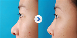 鼻頭縮小整形價(jià)格詳解,因素、費(fèi)用及注意事項(xiàng),鼻頭縮小整形價(jià)格解析,費(fèi)用、因素與注意事項(xiàng)全指南