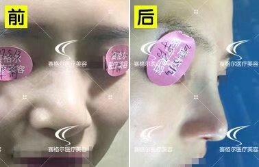 鼻頭縮小整形價(jià)格詳解,因素、費(fèi)用及注意事項(xiàng),鼻頭縮小整形價(jià)格解析,費(fèi)用、因素與注意事項(xiàng)全指南