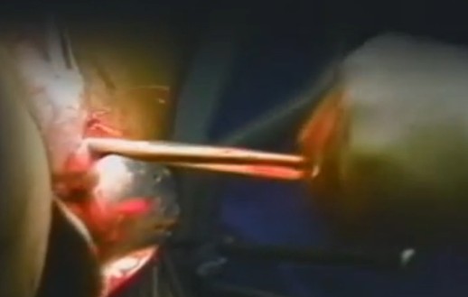 實(shí)拍醫(yī)院人流手術(shù)全過(guò)程,深入了解手術(shù)過(guò)程與細(xì)節(jié),醫(yī)院人流手術(shù)全過(guò)程實(shí)錄,探究手術(shù)過(guò)程與細(xì)節(jié)