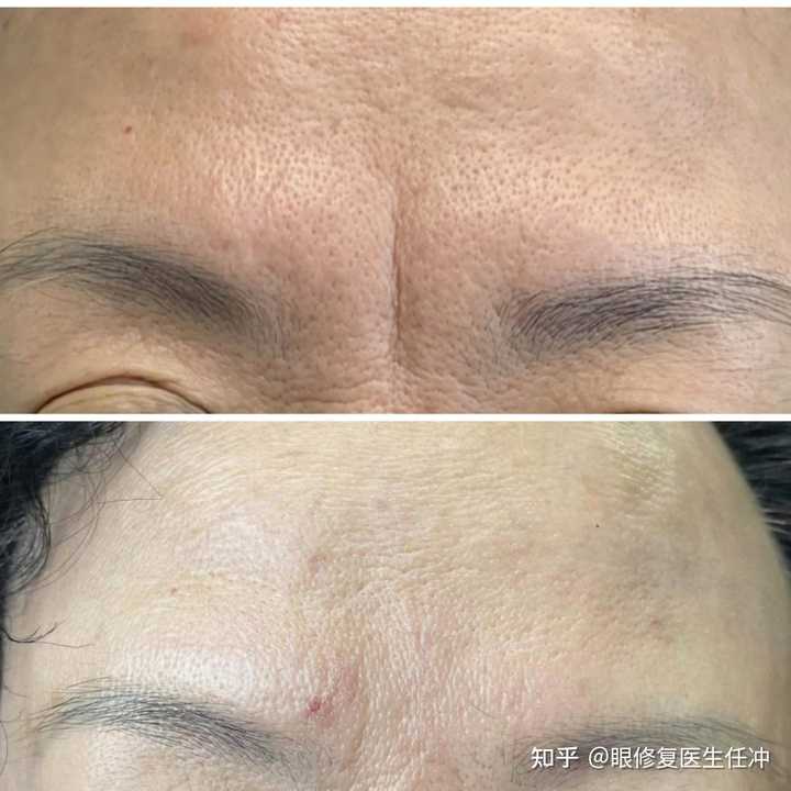 川字紋消除小偏方——讓你輕松告別皺紋困擾,川字紋消除偏方,告別皺紋,輕松展現年輕光彩!