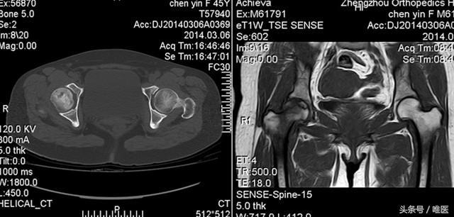股骨頭壞死的早期信號,識別與預防的關鍵步驟,股骨頭壞死的早期信號及識別預防關鍵步驟解析
