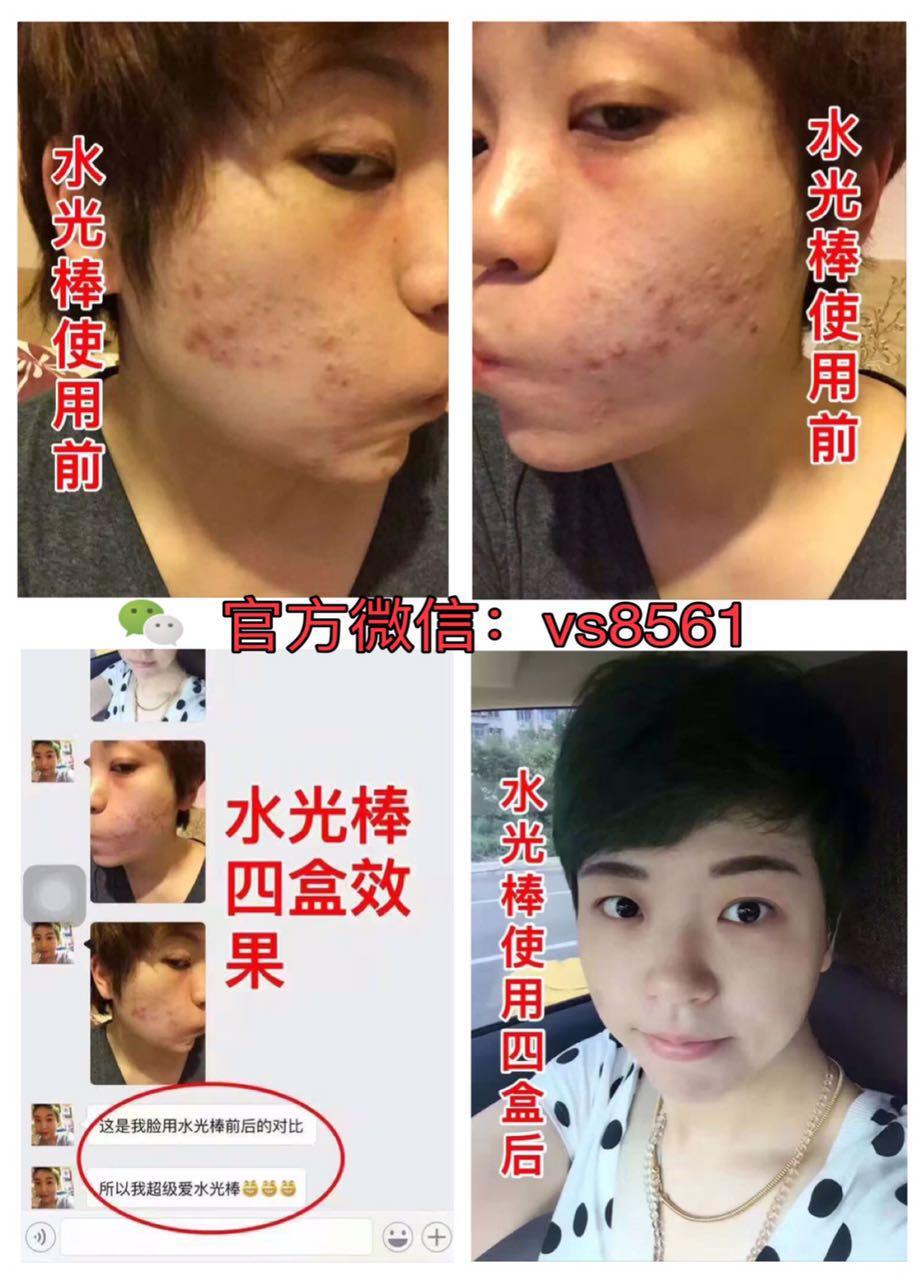 去除青春痘最有效的方法,全面解析最佳方案,全面解析,最有效的青春痘去除方案