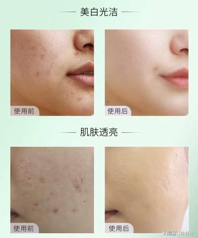 去除青春痘最有效的方法,全面解析最佳方案,全面解析,最有效的青春痘去除方案