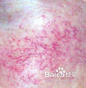 民間土方法根治紅血絲,民間土方法助您輕松消除紅血絲