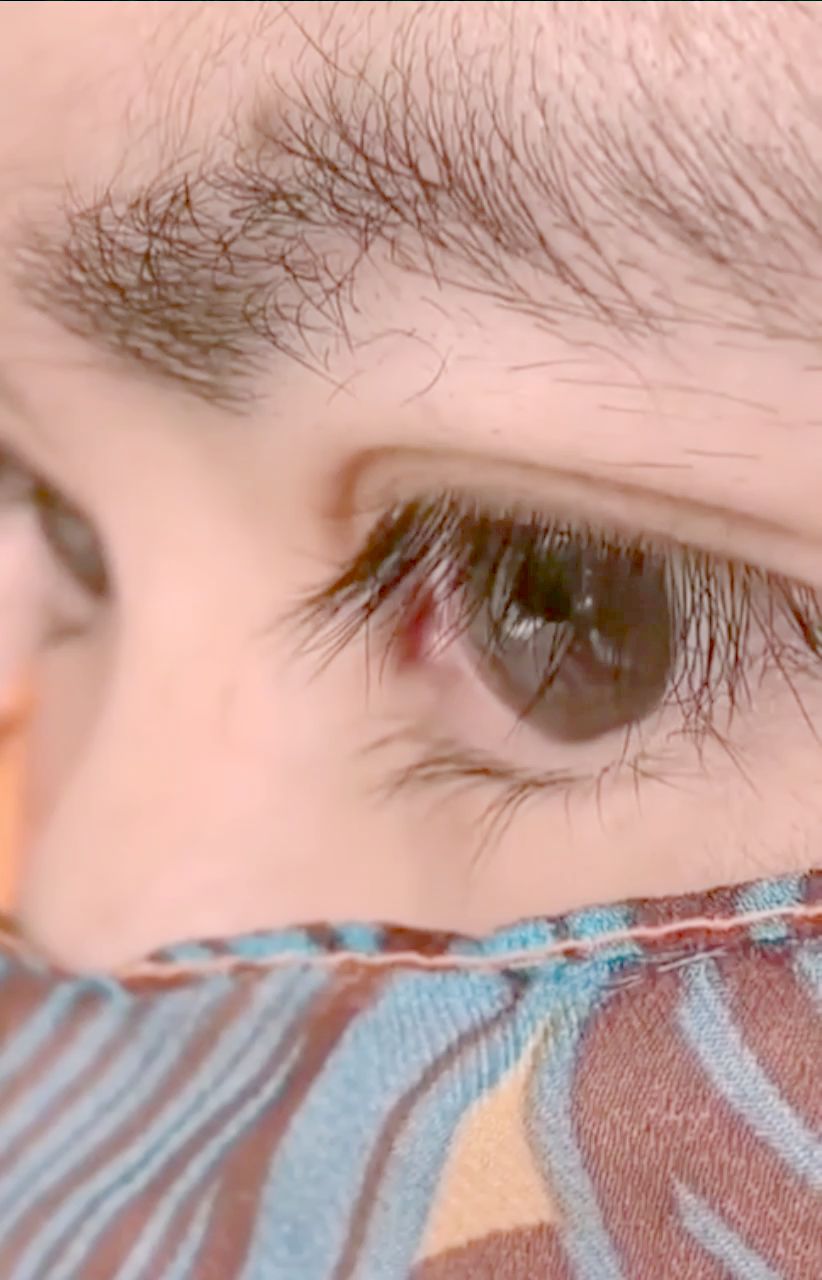 關于40歲割雙眼皮是否適合的全面解析,40歲割雙眼皮的適宜性與全面解析