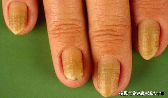 肝不好指甲圖片,揭示指甲變化與肝臟健康的關系,指甲變化揭示肝臟健康,圖片解析指甲與肝臟的聯系