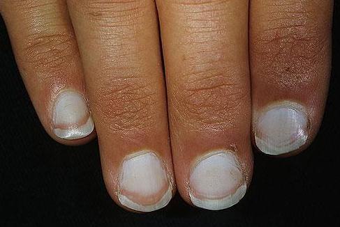 肝不好指甲圖片,揭示指甲變化與肝臟健康的關系,指甲變化揭示肝臟健康,圖片解析指甲與肝臟的聯系