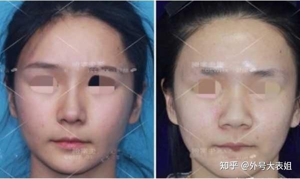 鼻翼縮小術對比照片,了解效果與變化,鼻翼縮小術對比照片,效果與變化的直觀展示