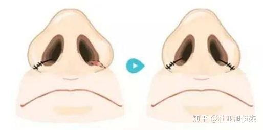 鼻翼縮小術對比照片,了解效果與變化,鼻翼縮小術對比照片,效果與變化的直觀展示