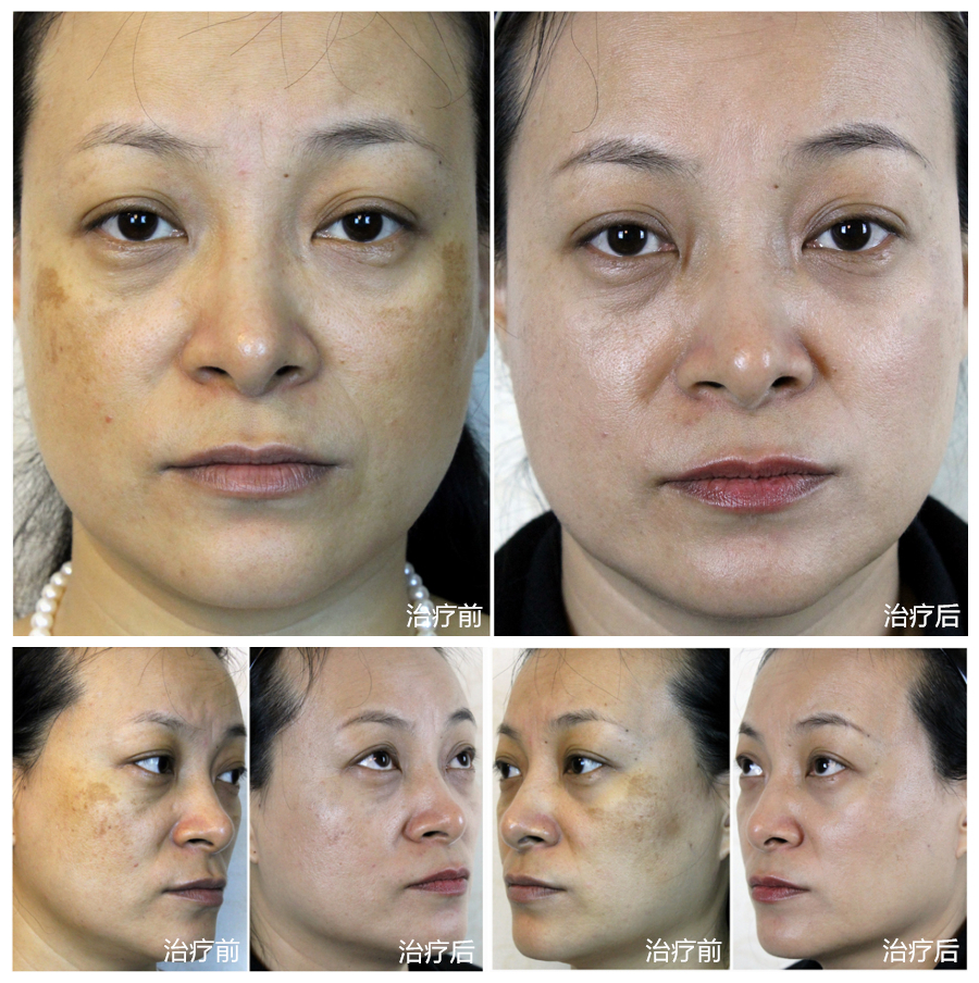 怎樣祛除黃褐斑最有效的方法,最有效的黃褐斑祛除方法
