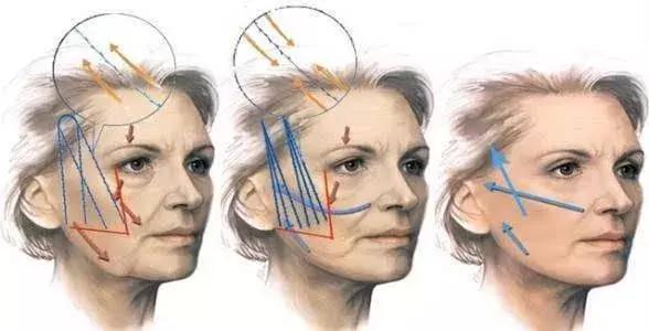 除皺針的價格,一針多少錢?全面解析費用因素,全面解析,除皺針價格,一針究竟多少錢?