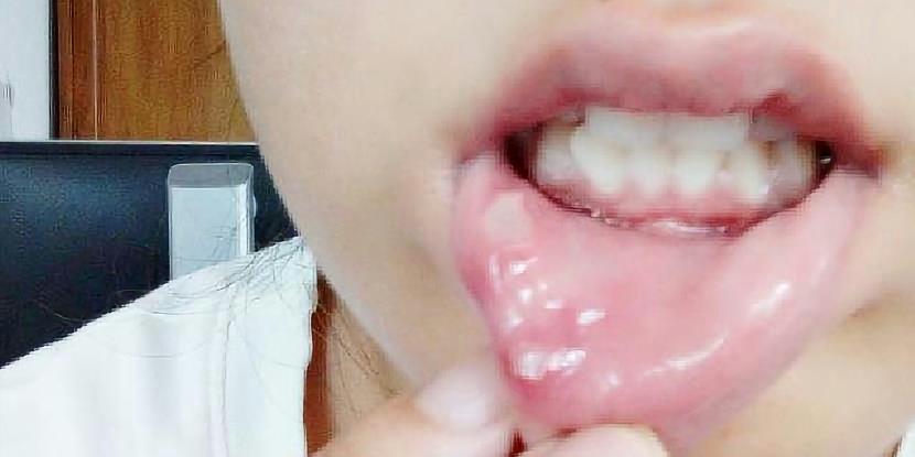 口腔潰瘍最快自愈方法，自然恢復與預防策略，口腔潰瘍自然恢復與預防策略，快速自愈方法及日常預防建議