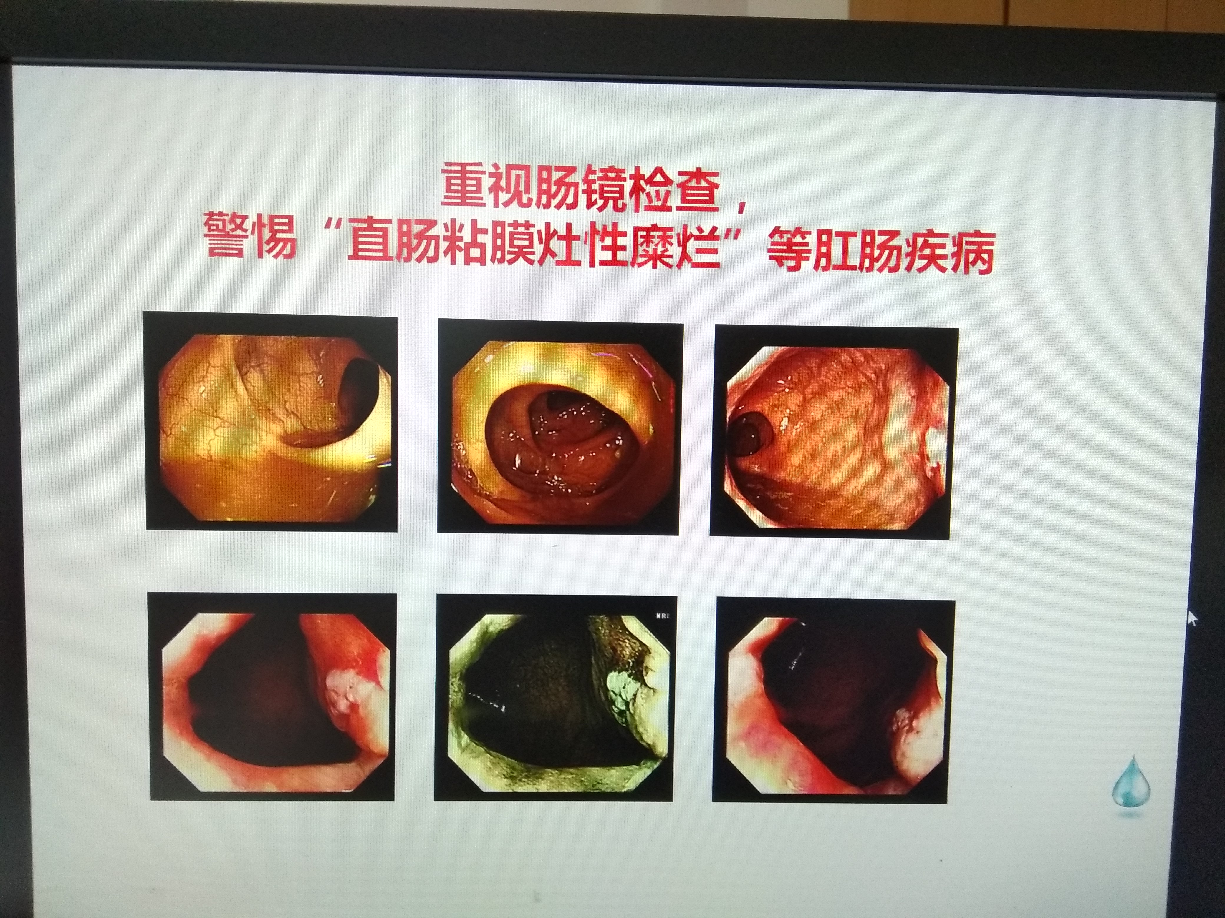 腸鏡檢查，一次不愉快的經歷，腸鏡檢查，一次難忘的不愉快體驗