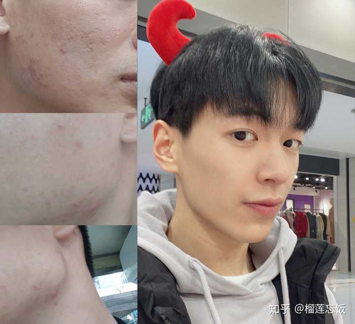 如何有效去除臉上的痘印——全方位指南，全方位指南，如何有效去除臉上痘印的方法