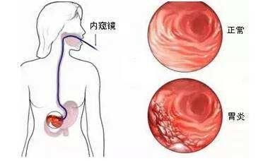 淺表性胃炎的癥狀及其影響,了解、預防與治療,淺表性胃炎的癥狀、影響、預防與治療全解析