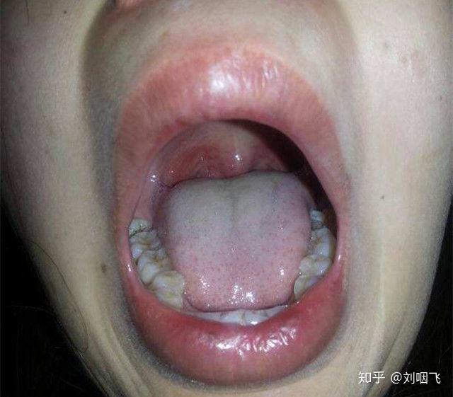 十個咽炎九個肺癌,深度解析與防治策略,深度解析,咽炎與肺癌關聯及防治策略