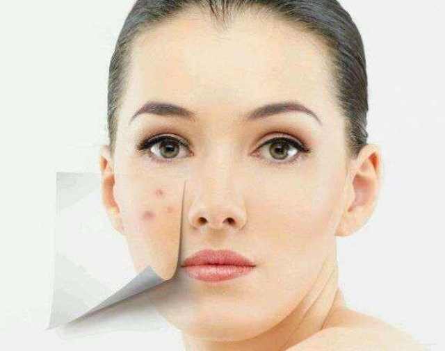 如何去掉青春痘小妙招,實用指南助你擺脫肌膚困擾,青春痘消除小妙招,實用指南助你擺脫肌膚問題